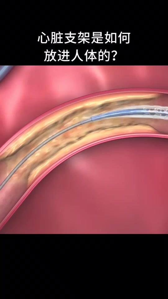 心脏支架是如何放进人体的?